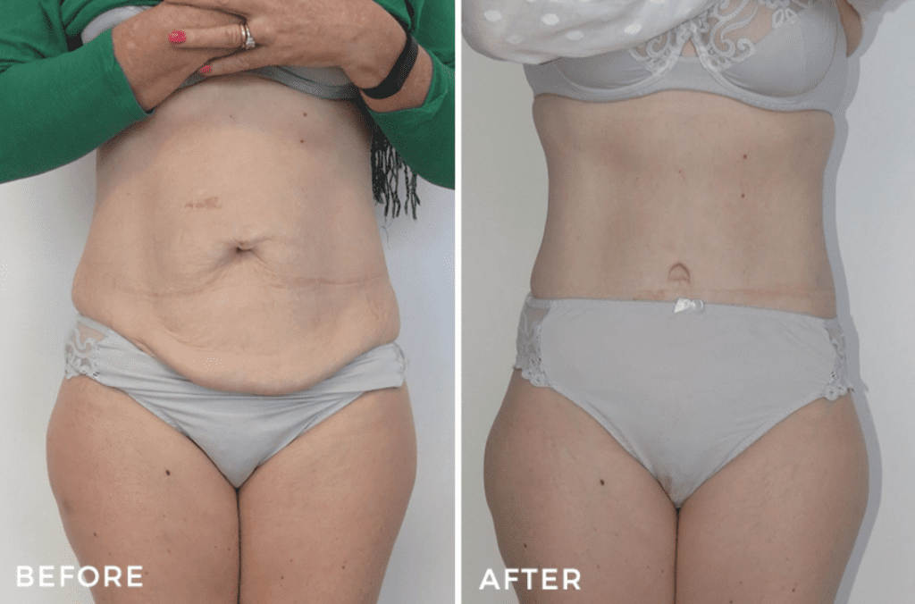 Tummy tuck before and after