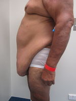 before panniculectomy